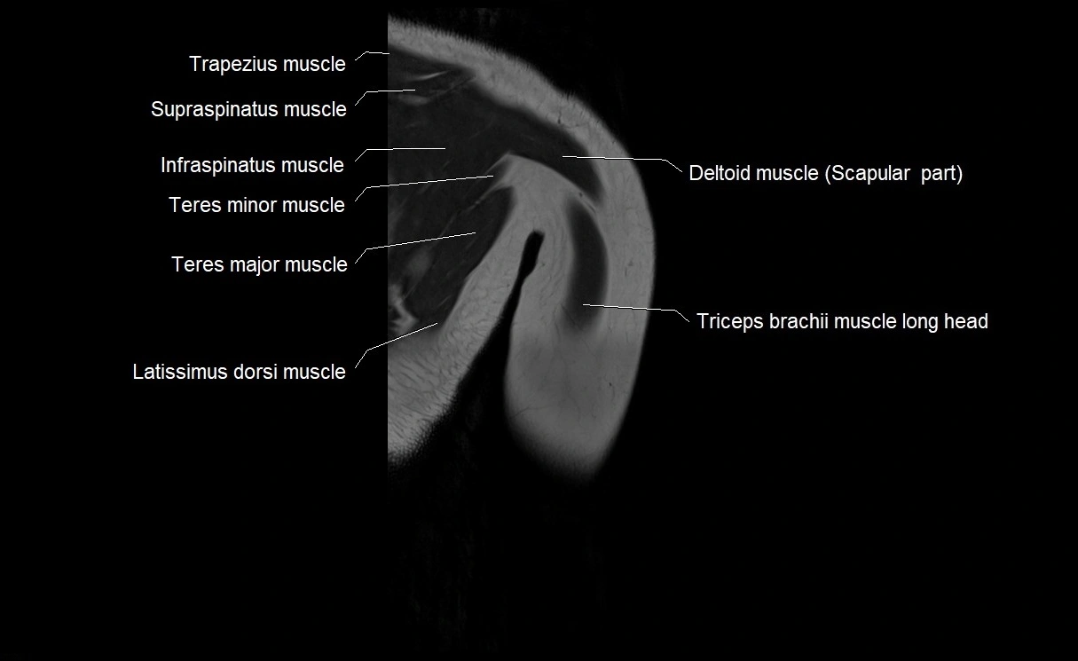MRI upper arm (humerus ) coronal cross sectional anatomy image 29.webp